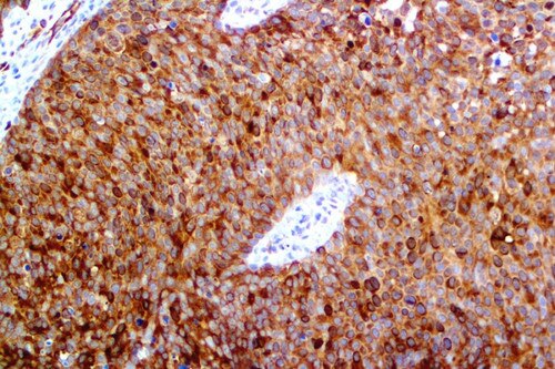 IHC of Stathmin on an FFPE Anal Carcinoma Tissue